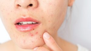 acne on face due to hormonal imbalance